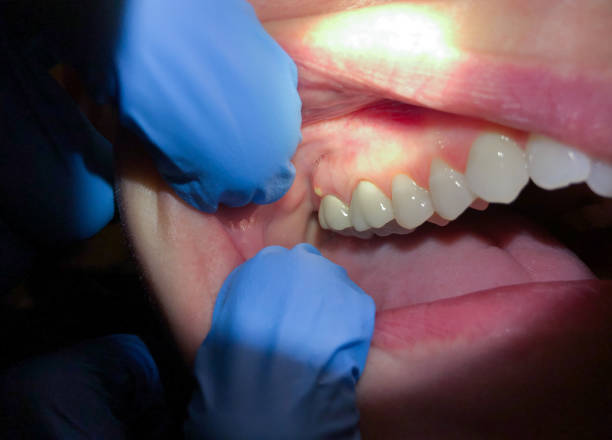 Best Emergency Dental Care for Broken or Chipped Teeth in Sixteen Mile Stand, OH
